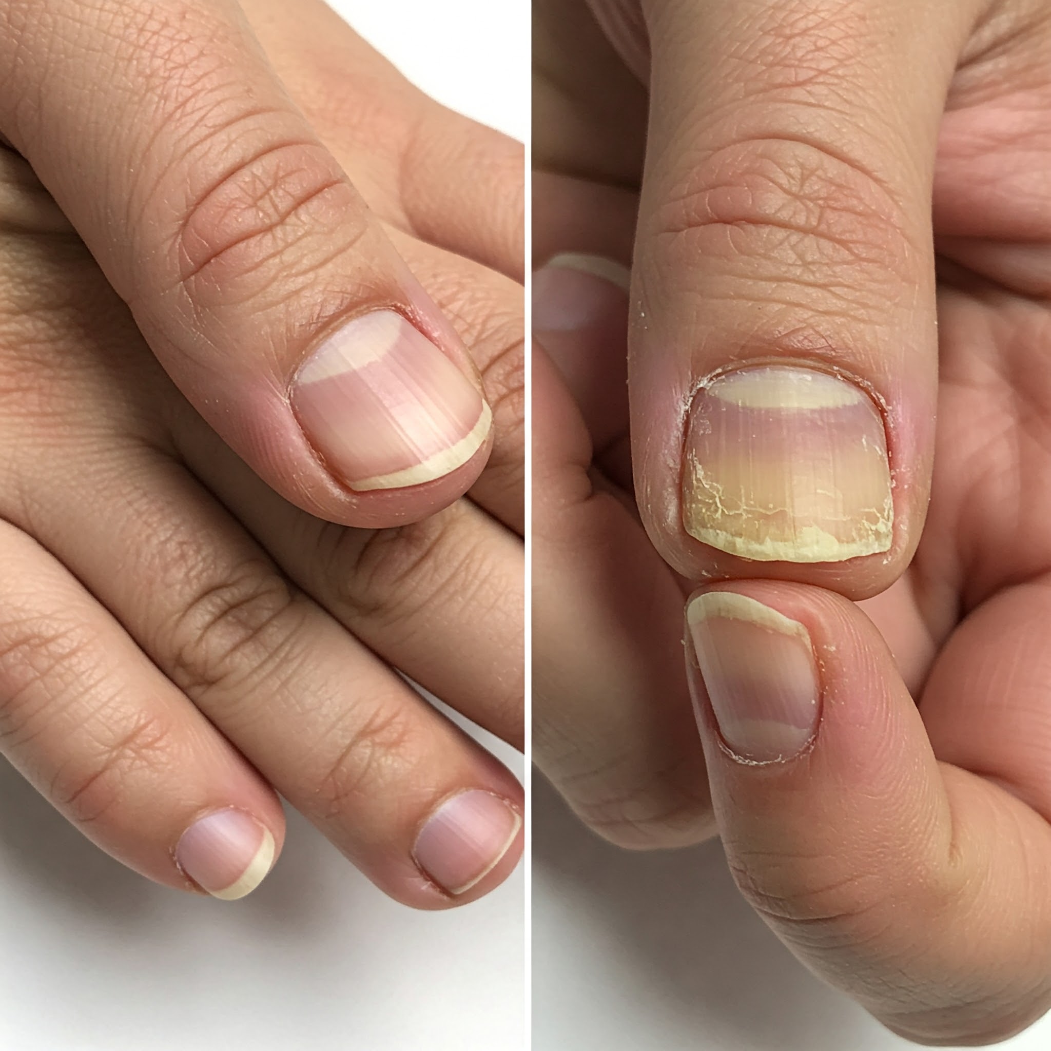 Nail Infection: How Nail Diseases and Abnormalities Signal Health Issues